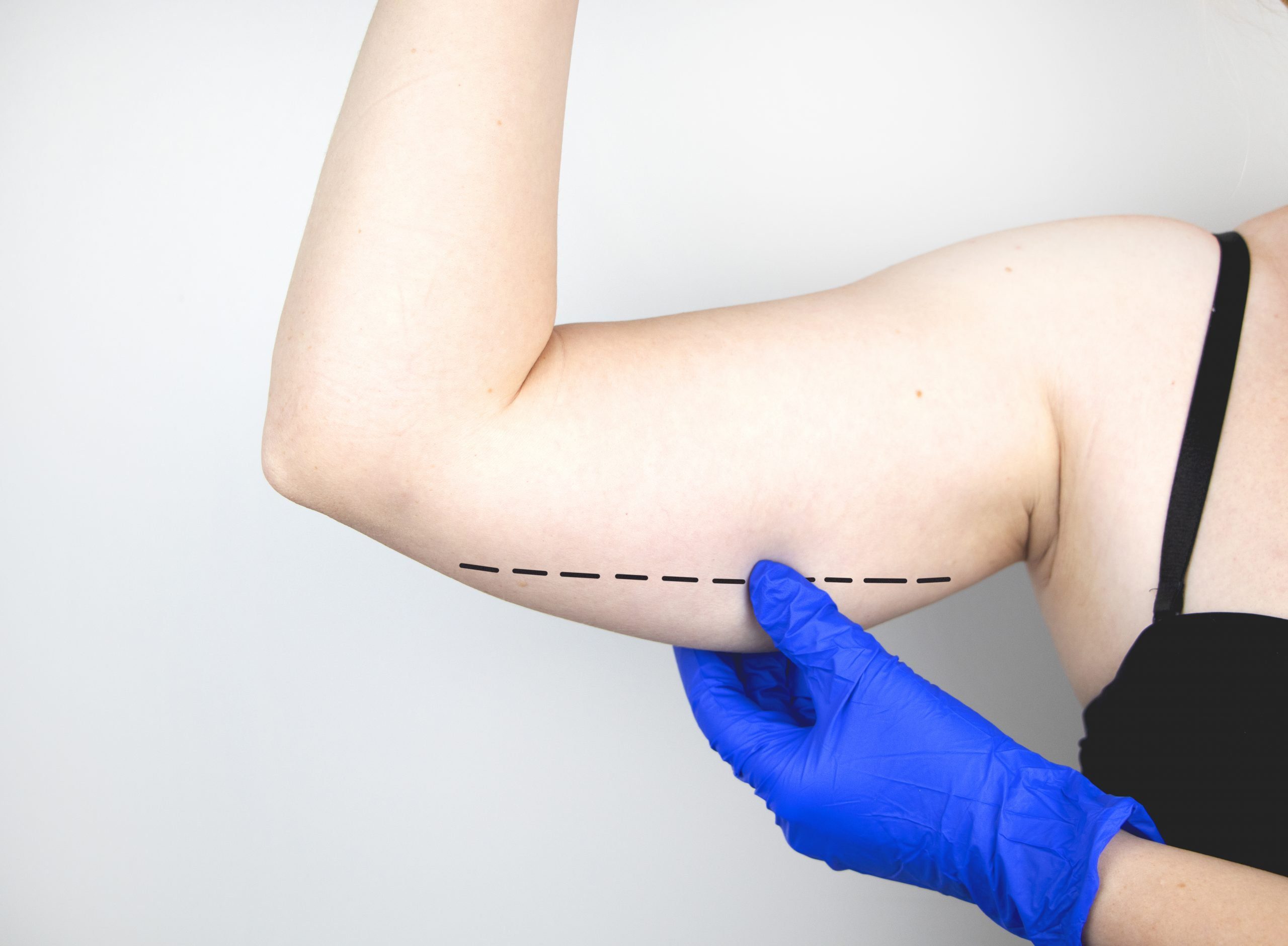 Überschüssige Haut und Fett an den Oberarmen Oberarmstraffung Sinaprivatklinik